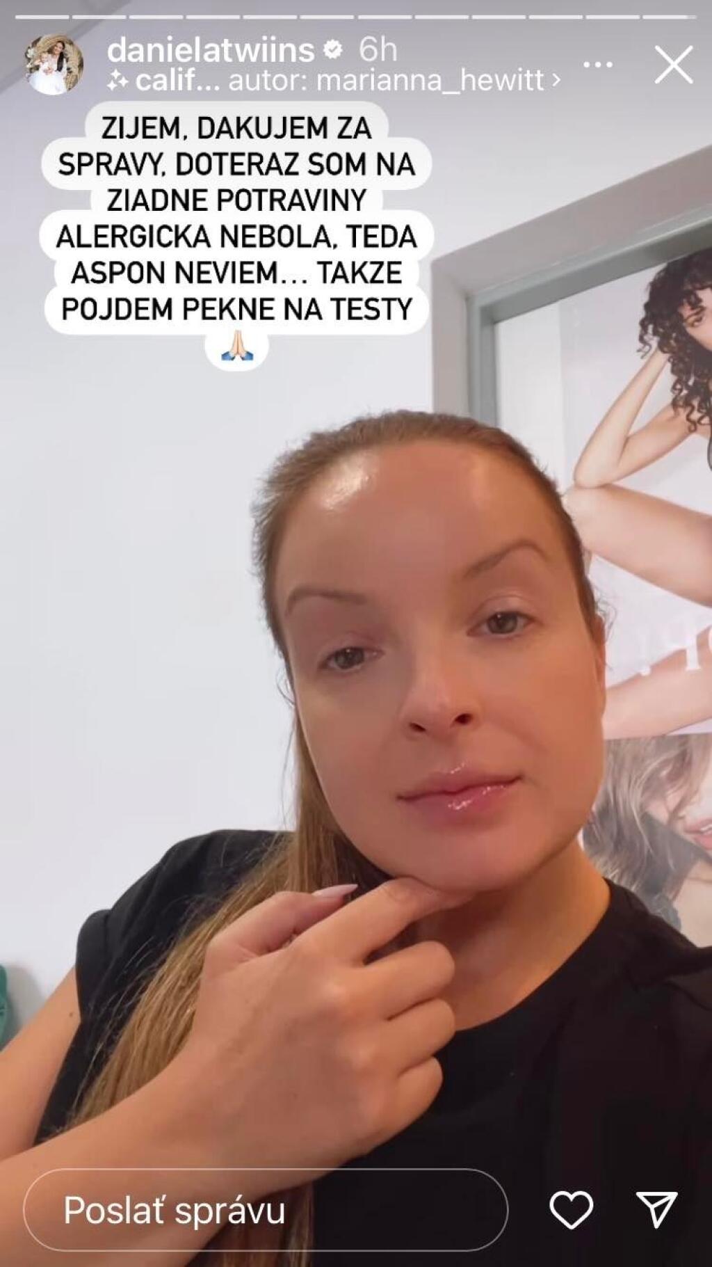 Twiinska Daniela Nízlová náhle skončila na urgentnom príjme. Dôvodom bola prudká alergická reakcia, z ktorej jej opuchla celá tvár vrátane pier aj jazyka.