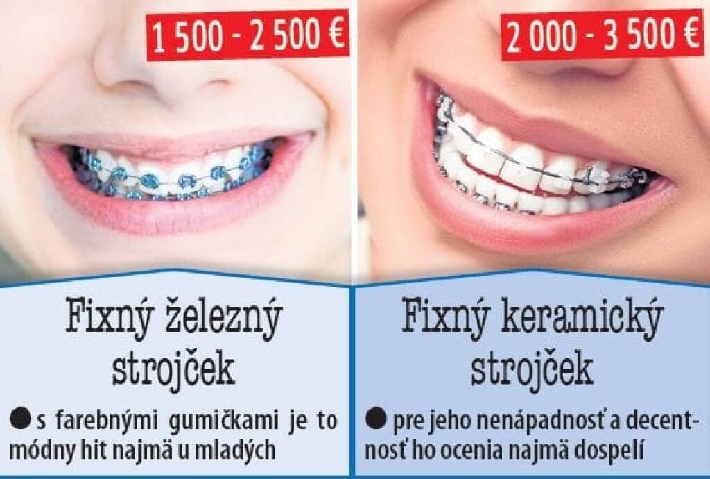 Rozdiel medzi damen a klasickym strojcekom na zuby