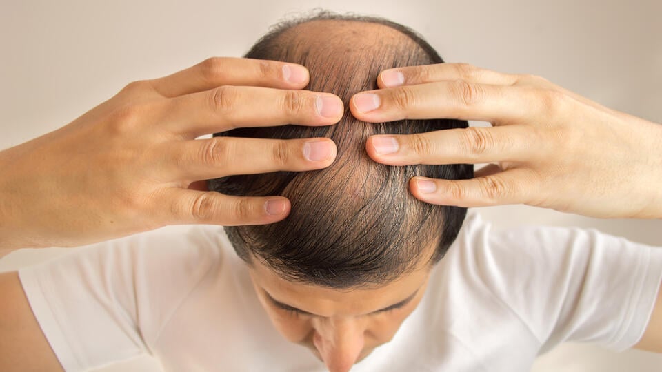 Close,Up,Of,Man,Controls,Hair,Loss