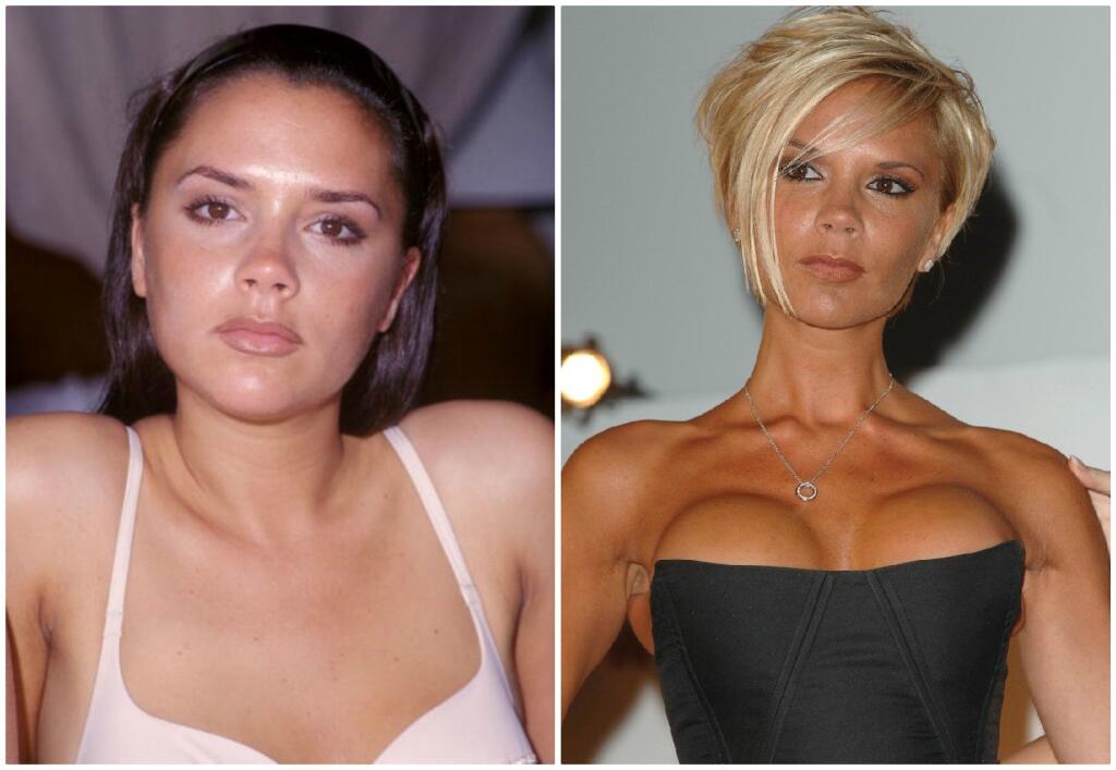 Manželka futbalistu Victoria Beckham (44) sa netajila tým, že si nechala zväčšiť prsia. Výsledný efekt jej krásu však viac ubral, čo bývalá členka skupiny Spice Girls pochopila a prsia si nechala opäť operovať po niekoľkých rokoch.