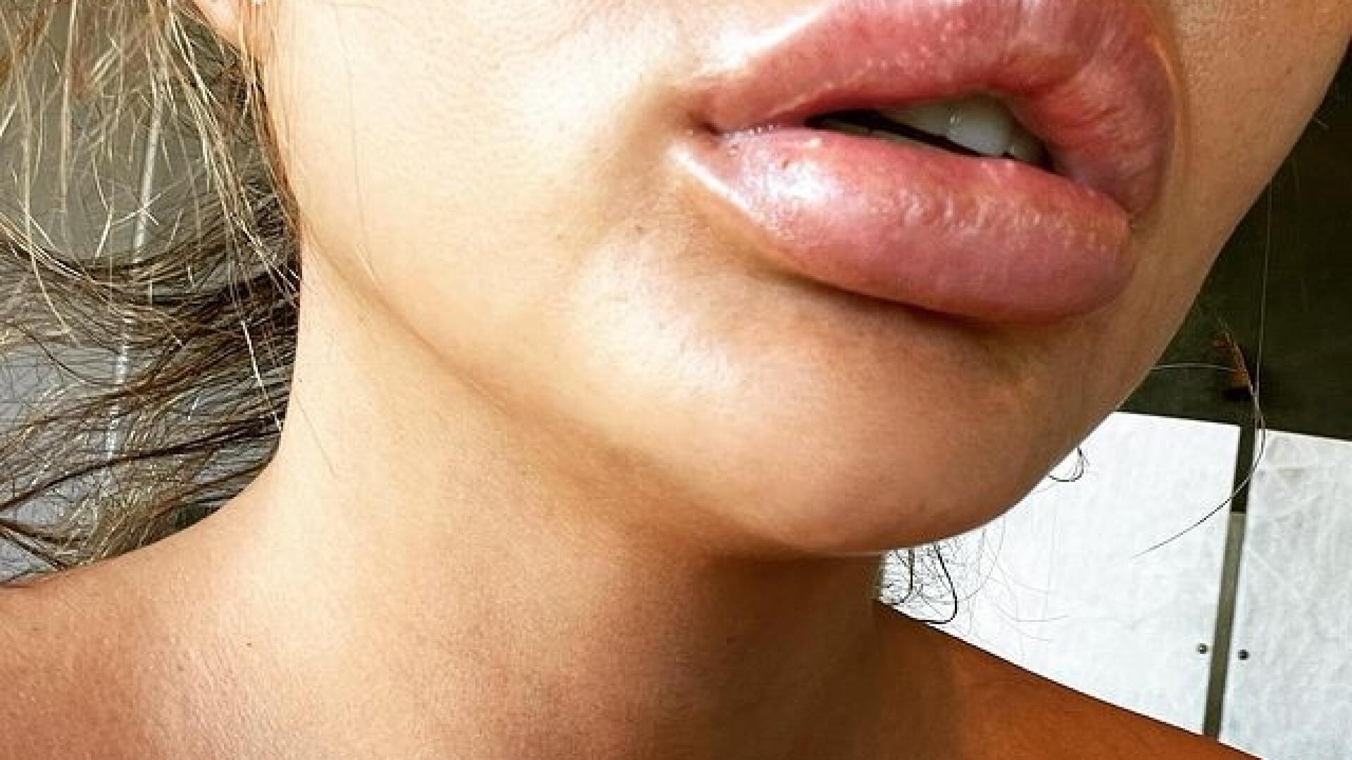 Воспаление филлера в губах