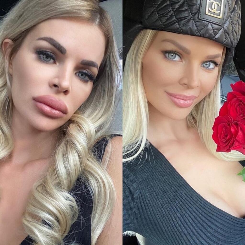 Silvia Kucherenko - súčasné pery sú konečne oveľa prirodzenejšie. Zmenšovali jej ich na 4-krát.