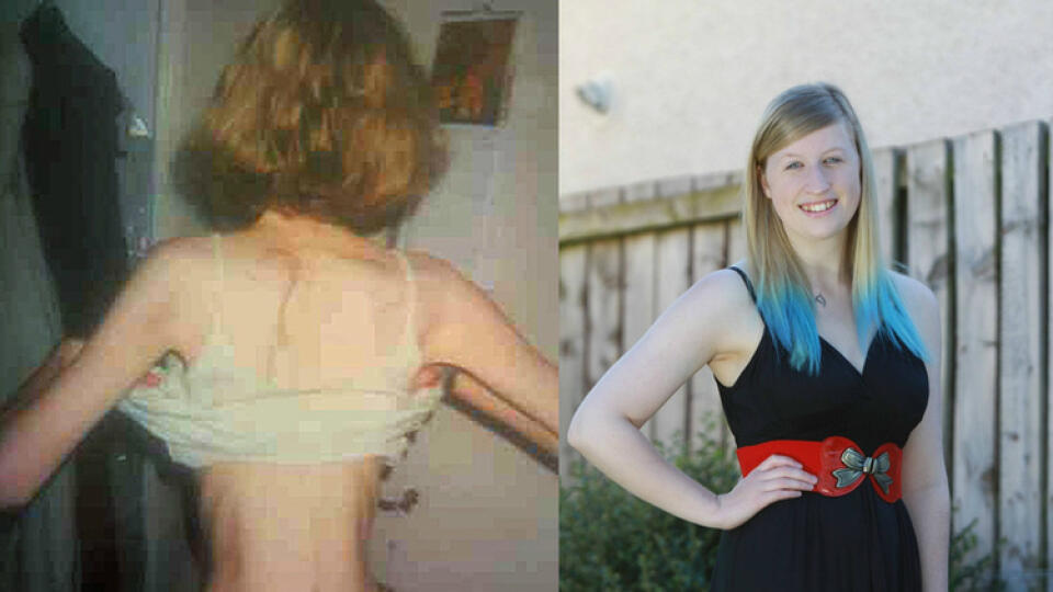 Anorexia jej ničila život, no Anna je teraz už zdravá a šťastná.
