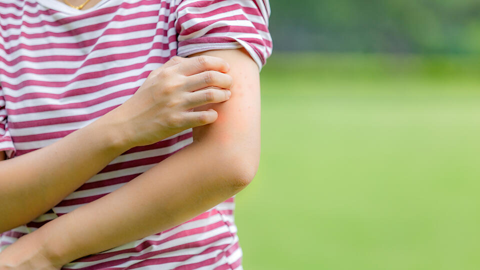 SOS tipy pri uštipnutí hmyzom