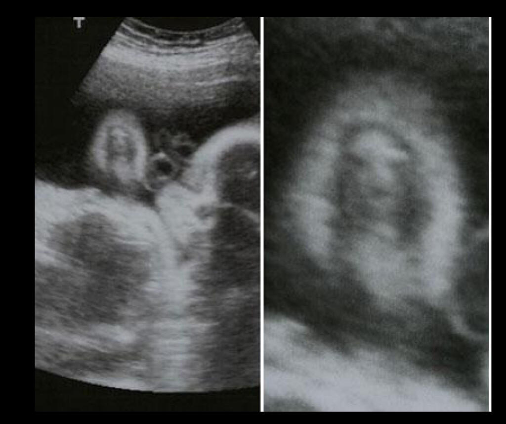 Страшные снимки УЗИ беременных