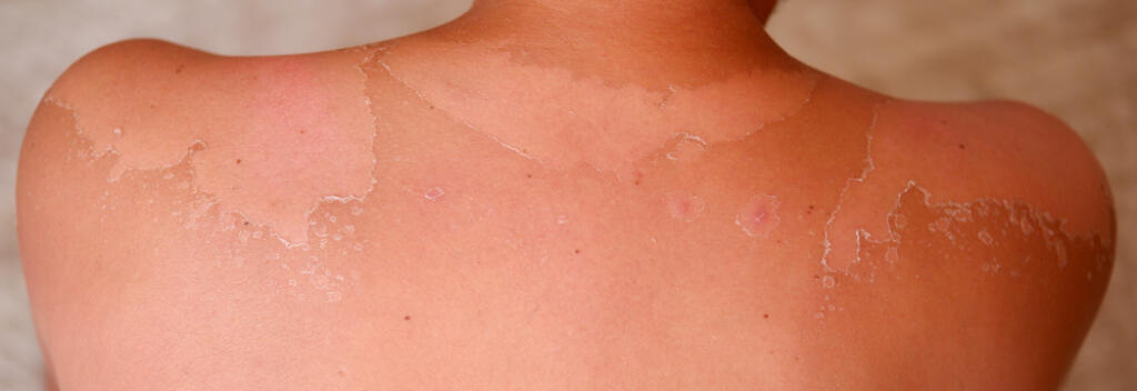 Close,Up,Shot,Of,Sunburn,And,Sunburn,Peeling.,Close,Up