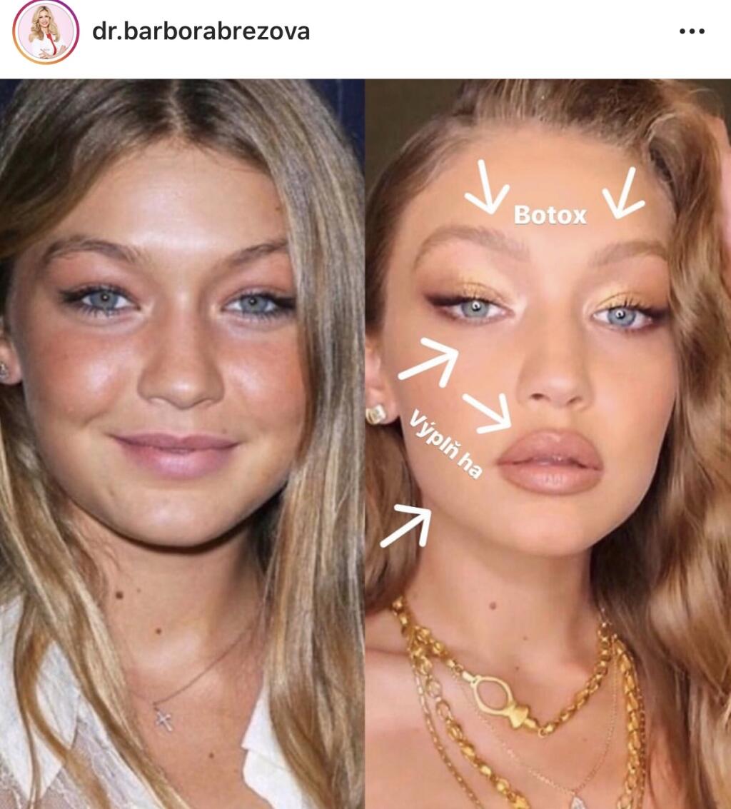 Jedna z najžiadanejších modeliek súčastnosti Gigi Hadid. Taktiež si rada dopomôže drobnými zákrokmi. Jemne nadvihnutie obočia či zúženie spodnej časti tváre sa docieli pomocou správnej aplikácie botulotoxínu. Korekcia oblasti pod očami a zvýraznenie pekných pier zas prostredníctvom kyseliny hyalurónovej. Takéto zákroky u mladých žien voláme “beautifikácia”. Ak sú vykonané skúseným lekárom s estetickým cítením ,kvalitnými materiálmi a správnou technikou, tak ani z dlhodobého hľadiska nemajú negat