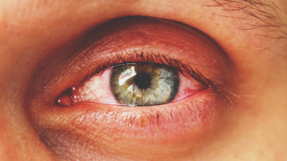 Red,Eye,Of,A,Patient,With,Human,Conjunctivitis,,Retro,Toned