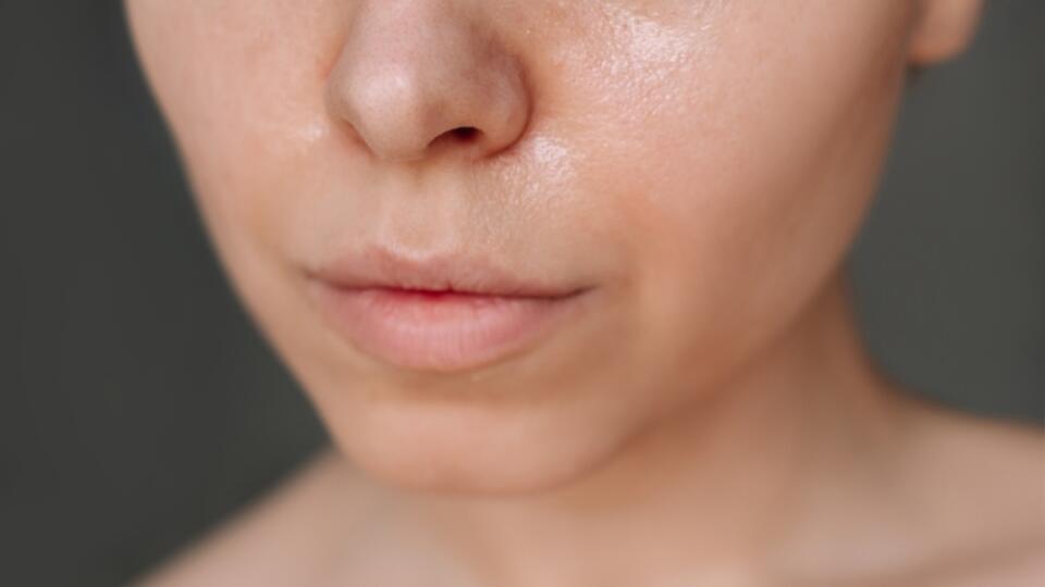 Cropped,Shot,Of,A,Young,Caucasian,Woman,With,Greasy,Skin