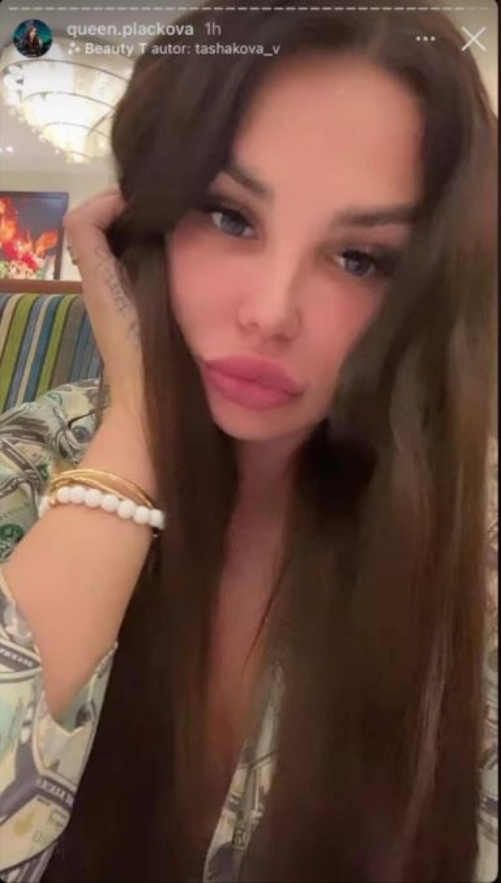 Aj keď za plastiku tváre vysolila 33-tisíc eur, Plačková musí neustále používať skrášľovacie filtre.