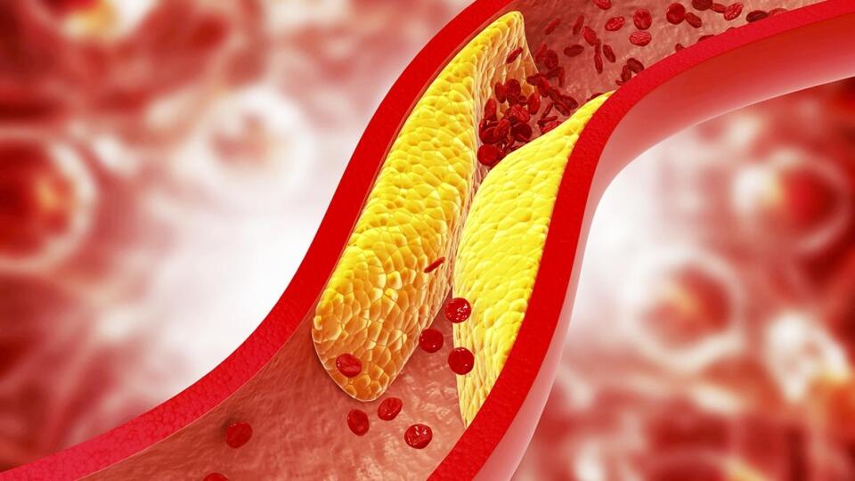 Za upchaté cievy môže hlavne zlý cholesterol.