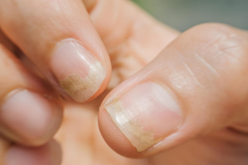 Onychomycosis,Or,Fungal,Nail,Infection,On,Thumb,And,Forefinger,,Sickness