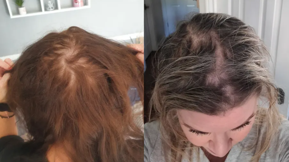 Olaplex súd: Viac ako 30 žien tvrdí, že utrpeli vypadávanie vlasov a poškodenie pokožky hlavy