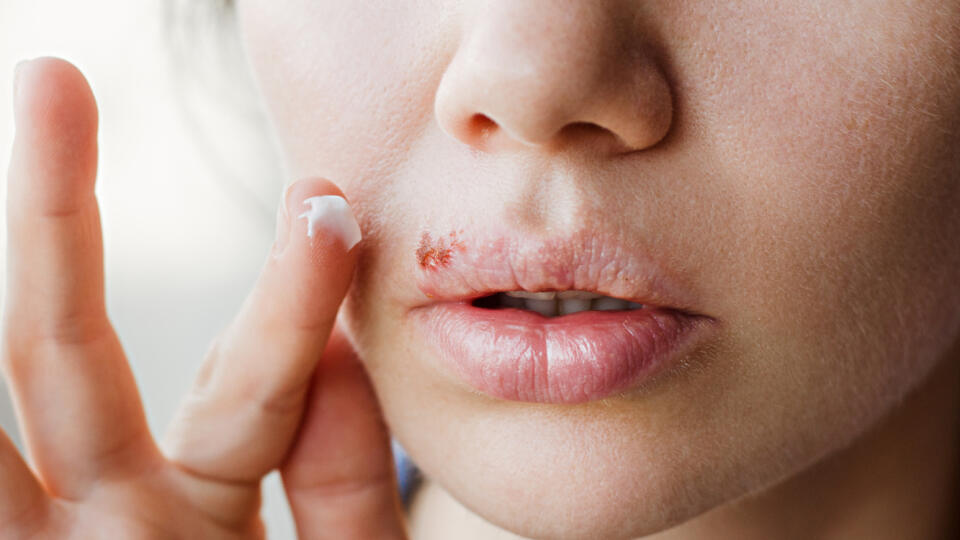 Part,Of,A,Young,Woman's,Face,With,A,Virus,Herpes