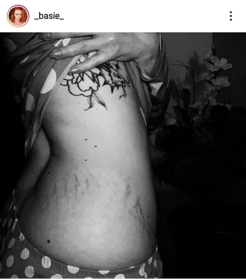 Speváčka Barbora Švidraňová nemá problém ukázať svoje strie.