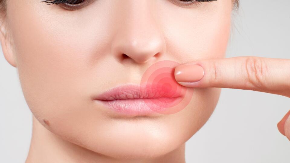 Close up of female lips affected by herpes virus
