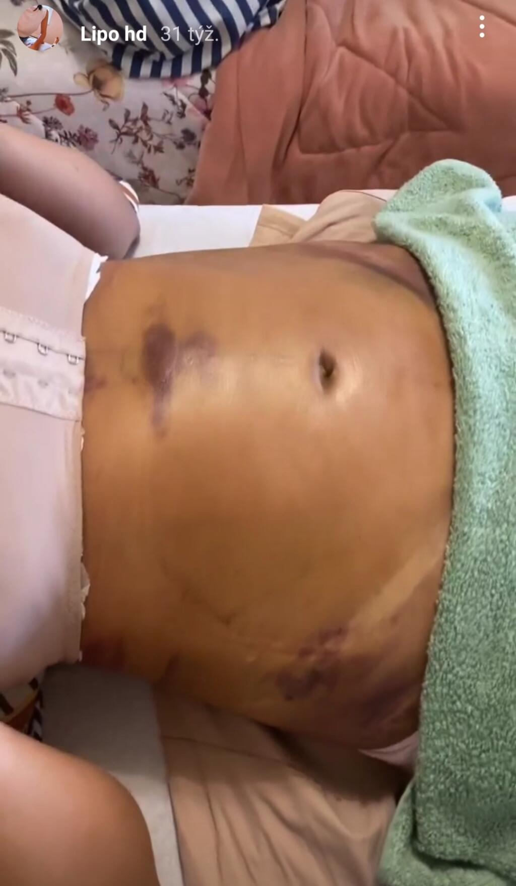 Niekto si ploché brucho vypracuje cvičením a niekto zase drahou liposukciou. Ingrid sa aj s ďalším zákrokom pýšila na Instagrame.