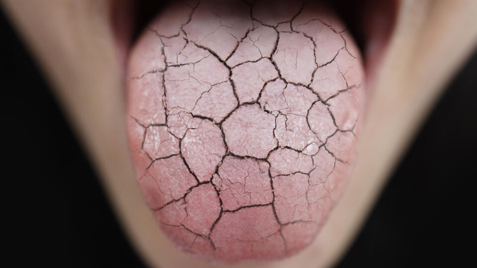 Woman,Unhealthy,Cracked,Dry,Tongue