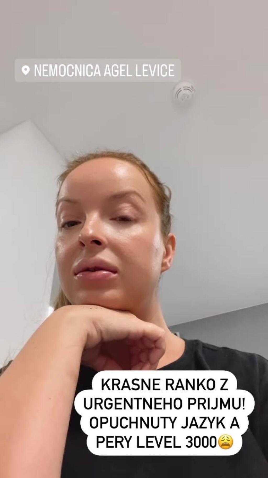 Twiinska Daniela Nízlová náhle skončila na urgentnom príjme. Dôvodom bola prudká alergická reakcia, z ktorej jej opuchla celá tvár vrátane pier aj jazyka.