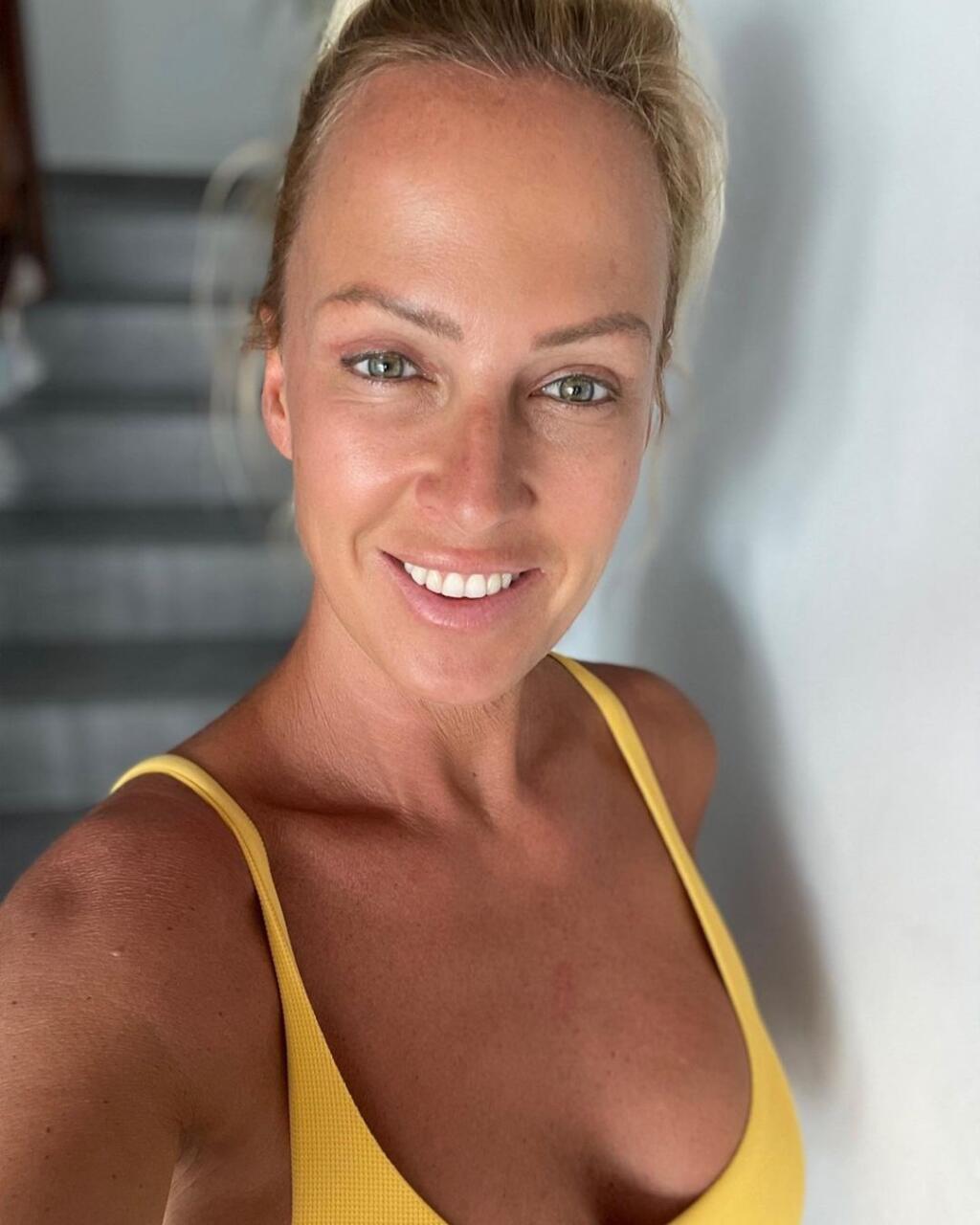 Zuzka Belohorcová po plastike.