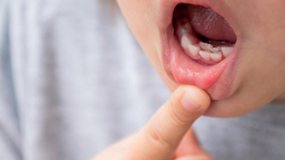 Little,Kid,Shows,Double,Row,Of,Teeth,In,His,Month.