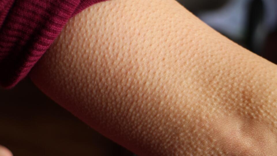 Skin Goosebumps