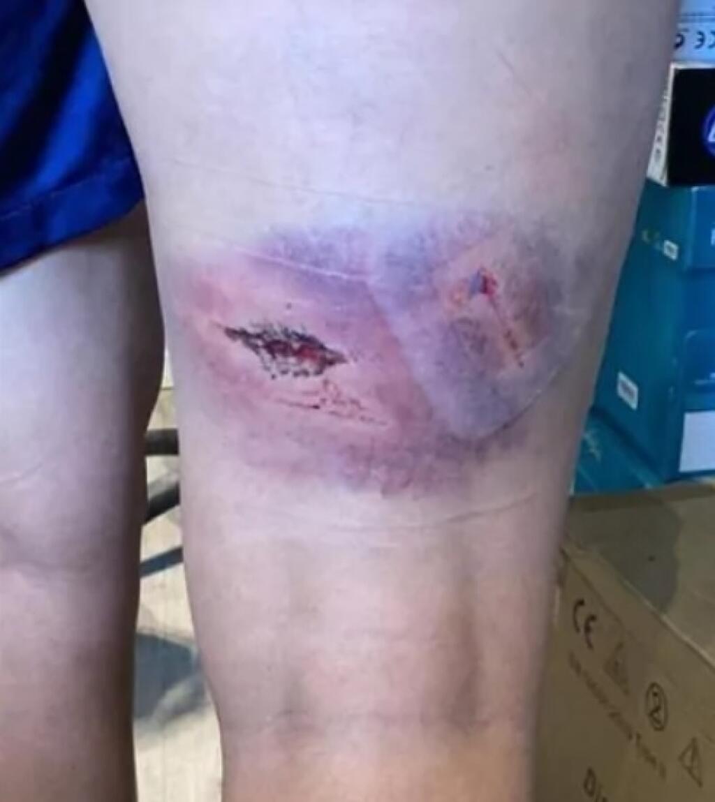 Takto vyzerá stehno futbalistky po tom, čo ju páchatelia mlátili železnými tyčami.