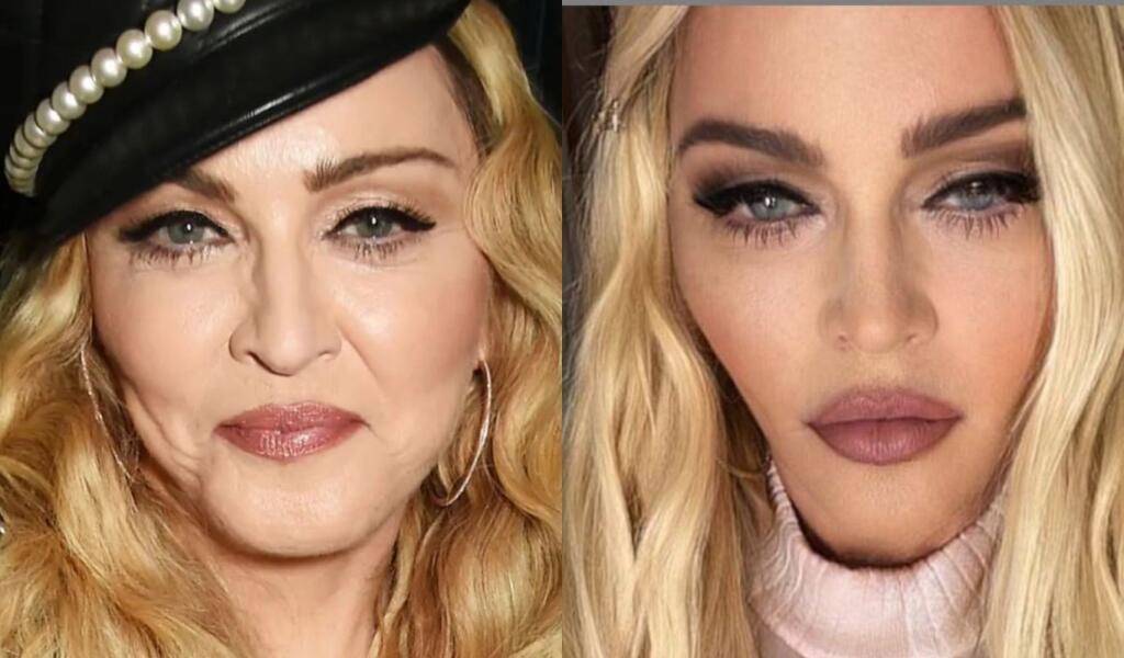 „Súdiac podľa fotografií by som povedal, že Madonna pravdepodobne absolvovala facelift, zdvihnutie horného a dolného viečka a endoskopický lifting. Madonna podľa všetkého podstúpila aj odstránenie bukálneho tuku, čo vytvára tenší profil a chudšie líca. Jej pokožka však vyzerá nedotknuto, čo je možný dôsledok viacerých chemických peelingov a laserových ošetrení,“ uviedol pre radaronline plastický chirurg doktor Youn.