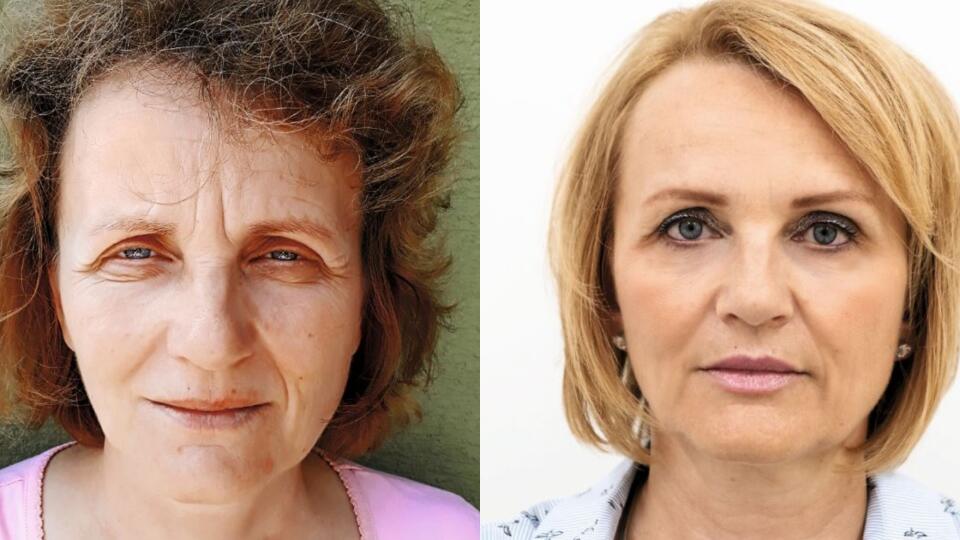 Áno, je to tá istá žena. Aj takéto zázraky dokáže kyselina hyalurónová a kombinácii s botulotoxínom. Pani nepodstúpila žiaden zásah plastického chirurga. Pri záverečnej úprave pomohla šikovná kaderníčka a kozmetička, hovorí MUDr. Lucia Podhorová.