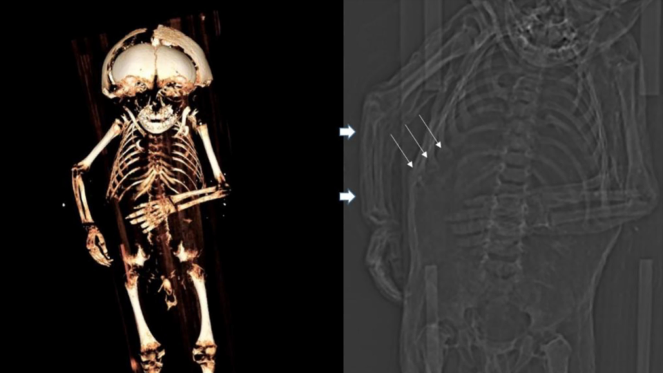 CT sken tela
a) - 3D rekonštrukcia kostry, b) výsek topogramu.