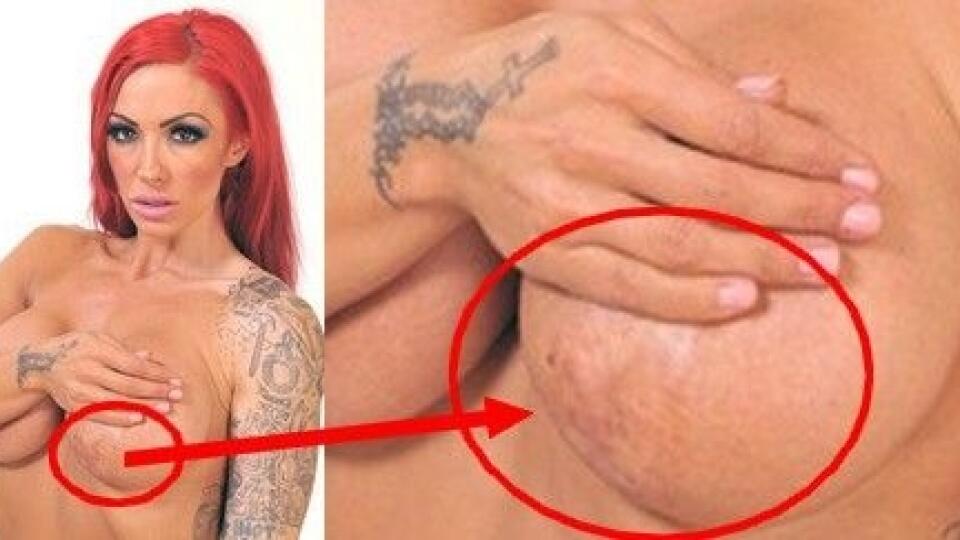 Ľavý prsník modelky Jodie Marsh hyzdí obrovská