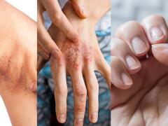 6 vážnych chorôb, ktoré prezradí vaša pokožka: Máte niečo z tohto na tele aj vy?