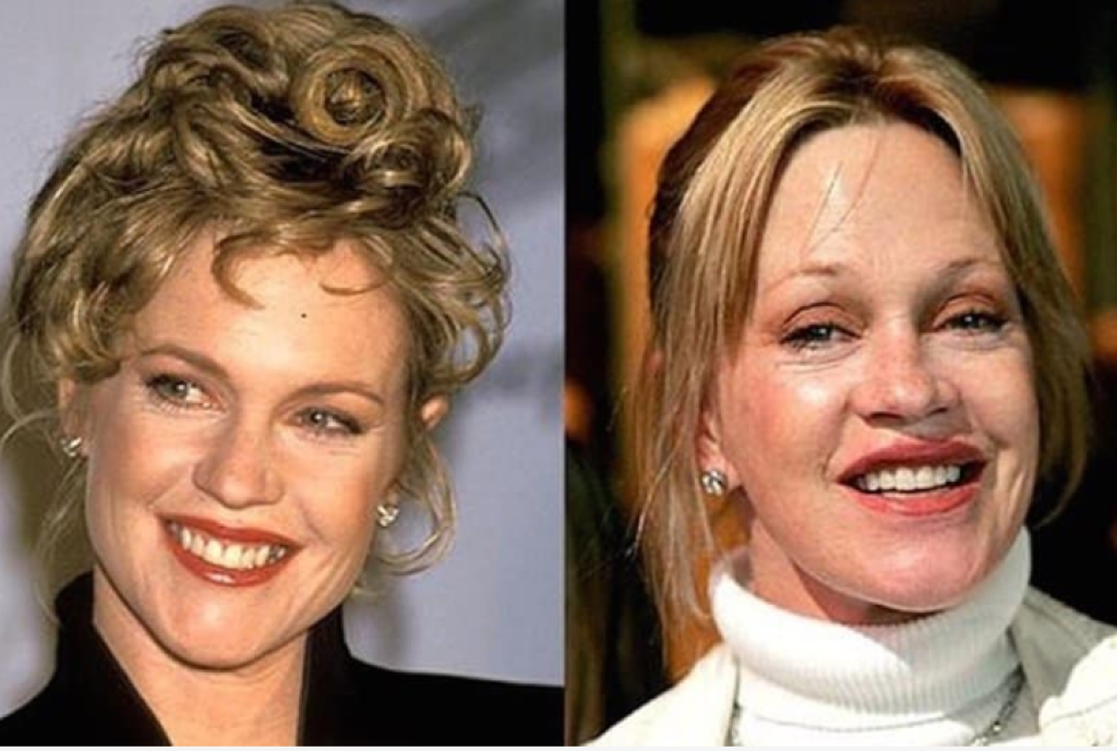 Melanie Griffith plastiky zmenili celkový výraz