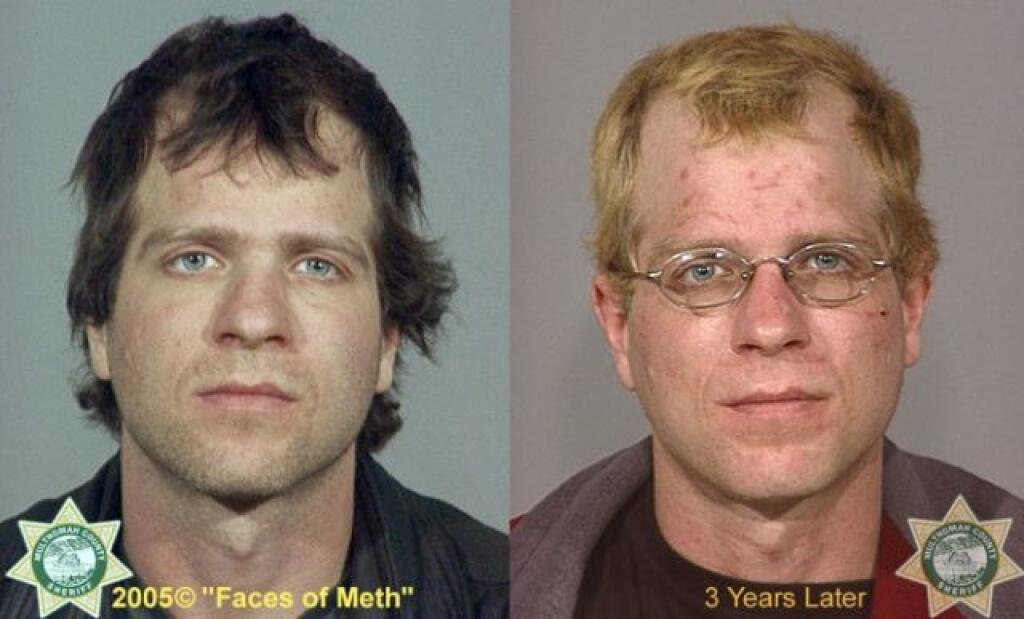 Вич носа. Люди до и после употребления наркотиков. Люди после метамфетамина. Лицо до и после наркотиков.