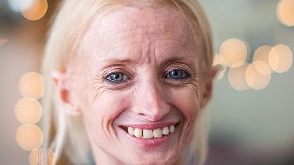 progeria