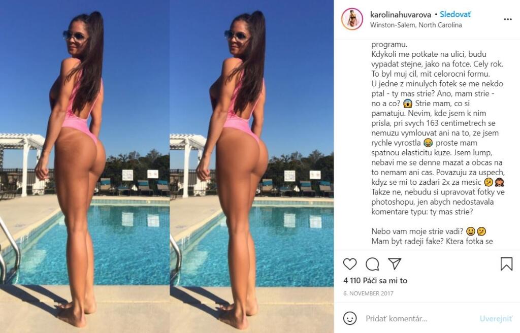 Napriek tomu, že mnohé ženy strie schovávajú, Huvarová si z nich ťažkú hlavu nerobí. „Nikto nie je dokonalý a je potrebné milovať aj svoje „vady na kráse“,“ vyhlásila.