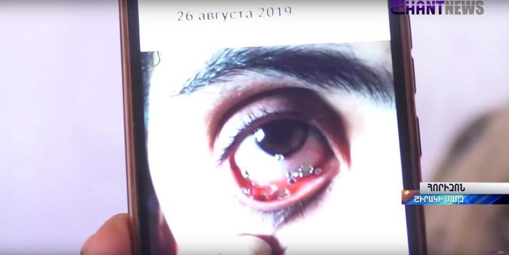 Mladá Arménka plače namiesto sĺz kryštály. Lekári jej nevedia pomôcť.