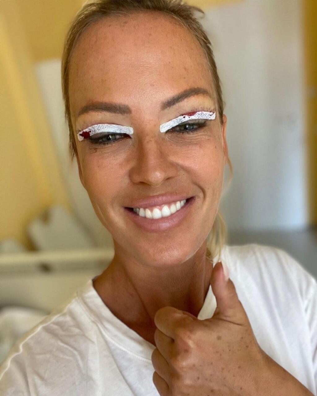 Zuzka Belohorcová po plastike.