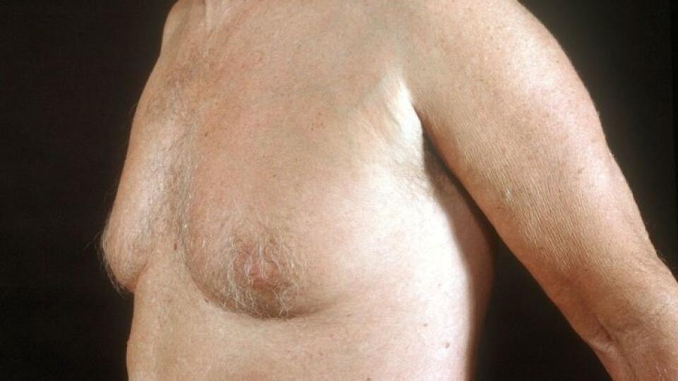 Po päťdesiatke, môže byť gynekomastia prejavom začínajúcej degenerácie pohlavných buniek.