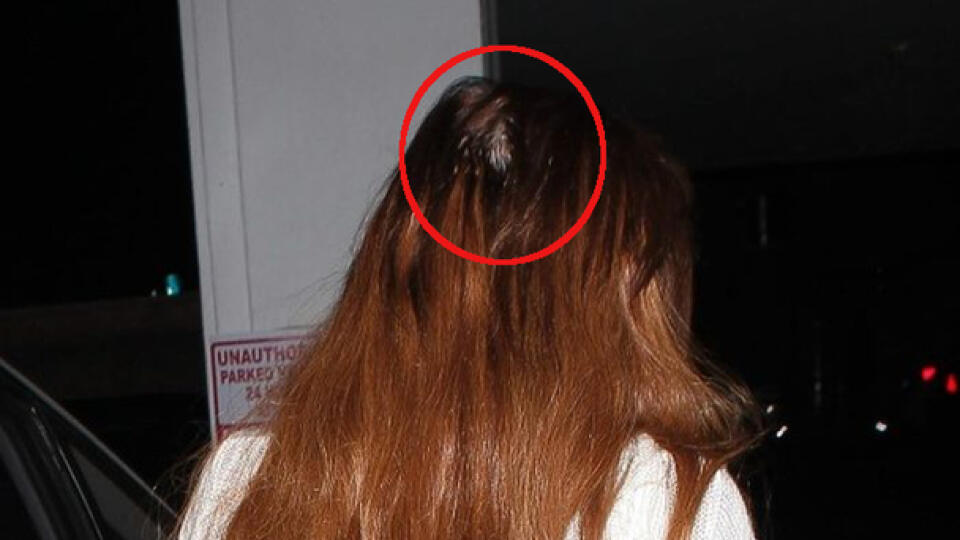 Z čoho Lindsay Lohan vypadali vlasy?