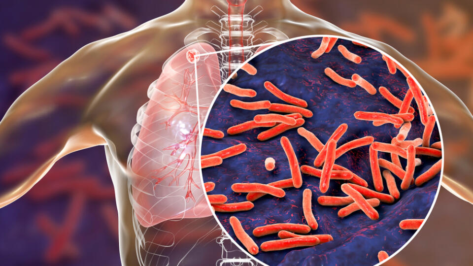 Secondary,Tuberculosis,In,Lungs,And,Close-up,View,Of,Mycobacterium,Tuberculosis