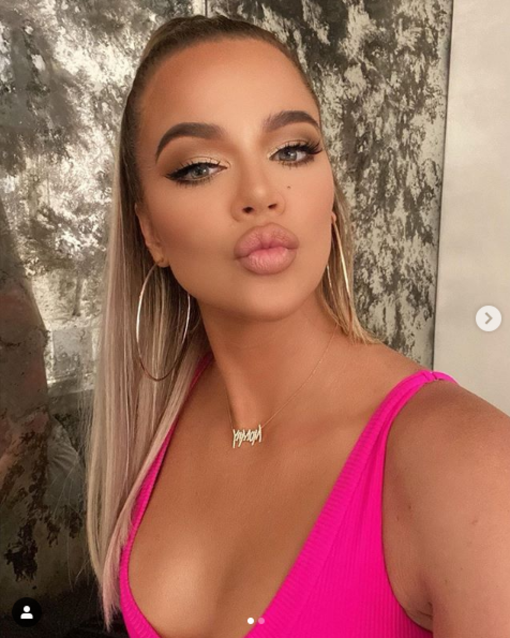Špekuluje sa, že Khloe Kardashian absolvovala plastickú operáciu.