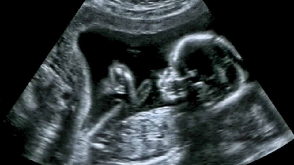 Malá bojovníčka ohúrila svet. Mozog jej operovali v maminkinom brušku