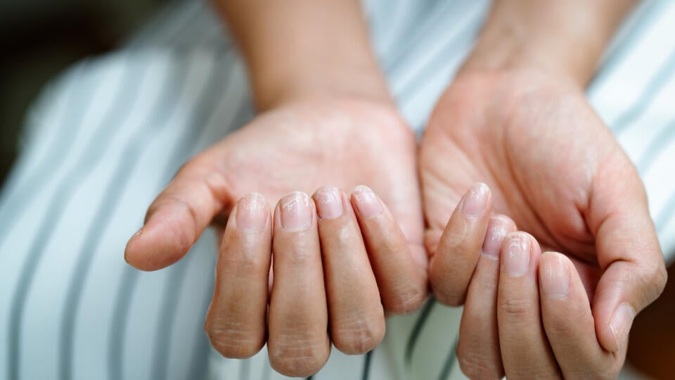 Lámavé nechty naznačujú nedostatok vitamínov.