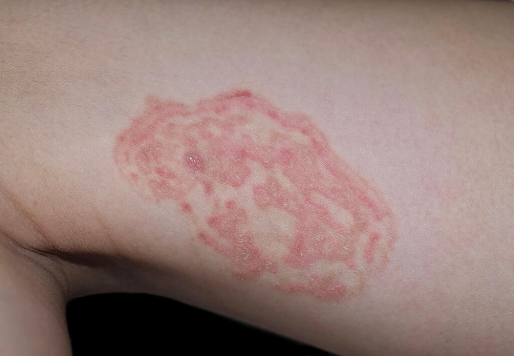 Tinea,Corporis,Or,Fungal,Infection,On,Thigh,Of,Southeast,Asian,