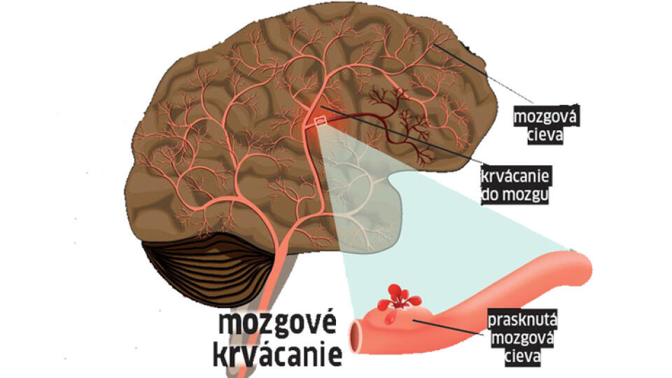 Aneuryzma, teda vydutie cievy, sa totiž vôbec nemusí prejaviť, až kým nepraskne.