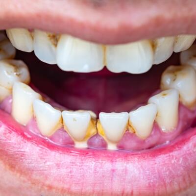 Zubný kameň mám dlhodobo. Keď ho dám odstrániť, môžu mi vypadnúť zuby?