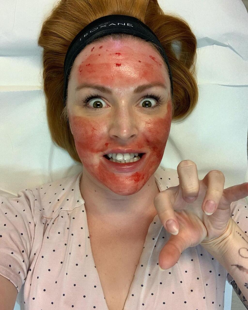 Barbora Švidraňová podstúpila Drakula terapiu. Takto vyzerala krátko pozákroku.