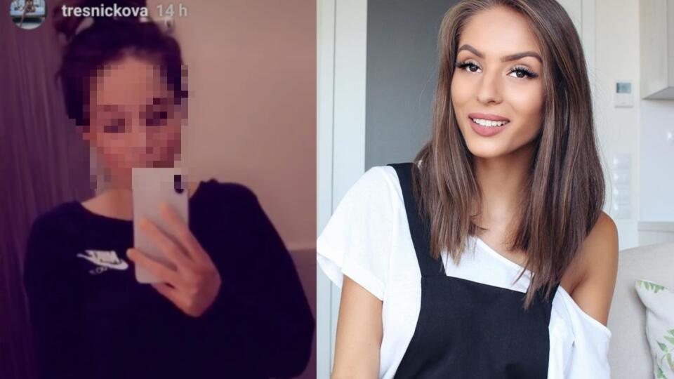 Česká youtuberka sa konečne odhodlala. Fanúšikom ukázala svoju popálenú tvár