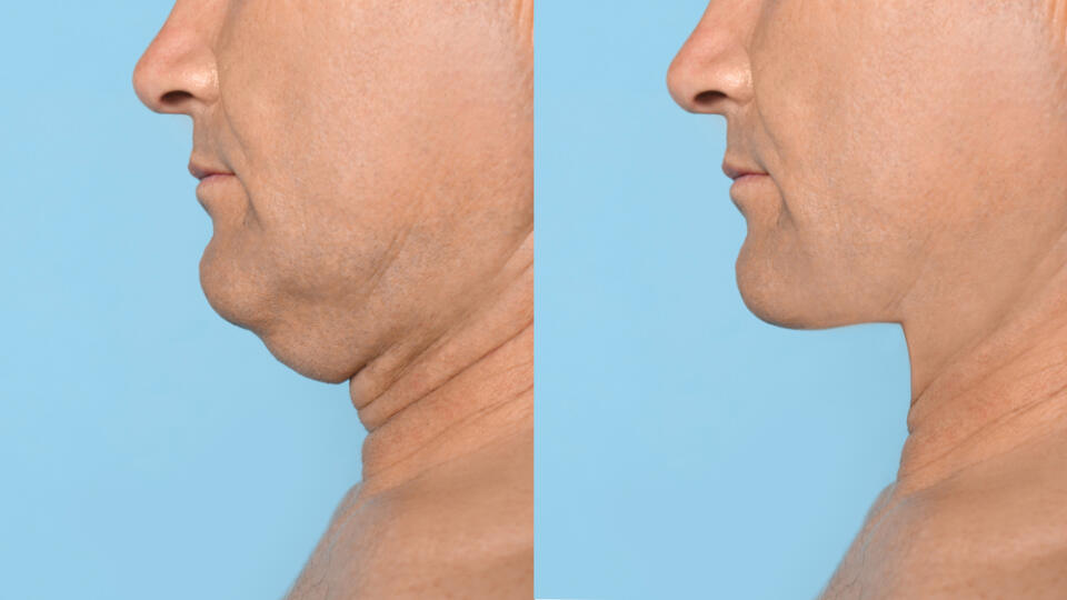 Mature,Man,Before,And,After,Plastic,Surgery,Operation,On,Blue